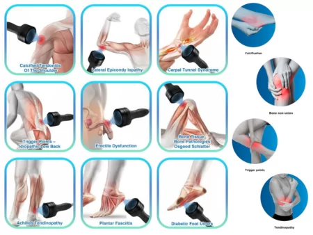 Focus Shockwave Therapy